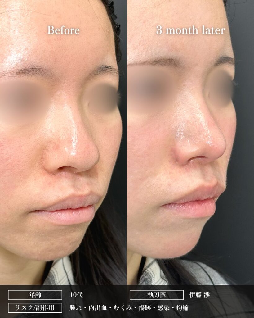 鼻尖形成と軟骨移植と小鼻縮小の症例写真 (37)