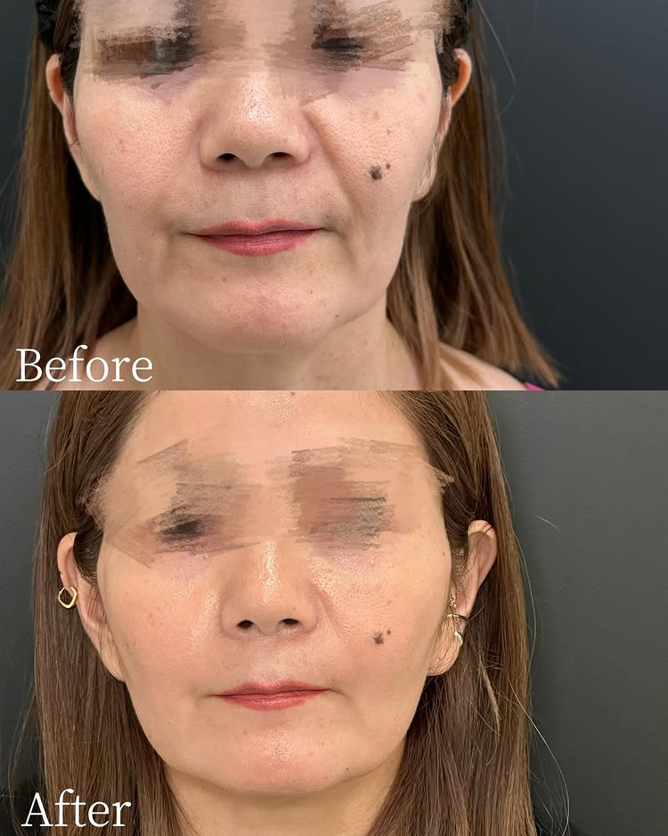 糸リフトの症例写真 (43)