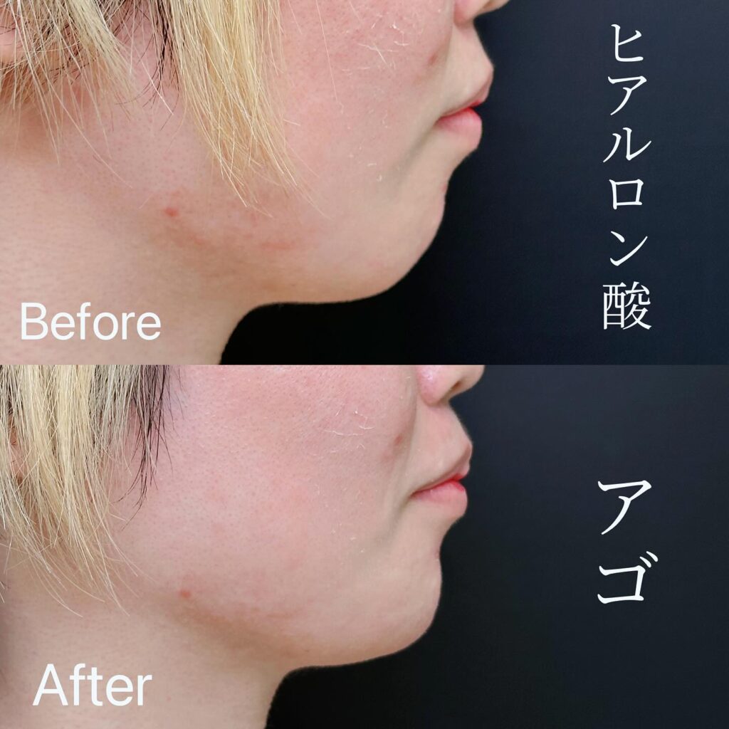 顎のヒアルロン酸の症例写真 (11)