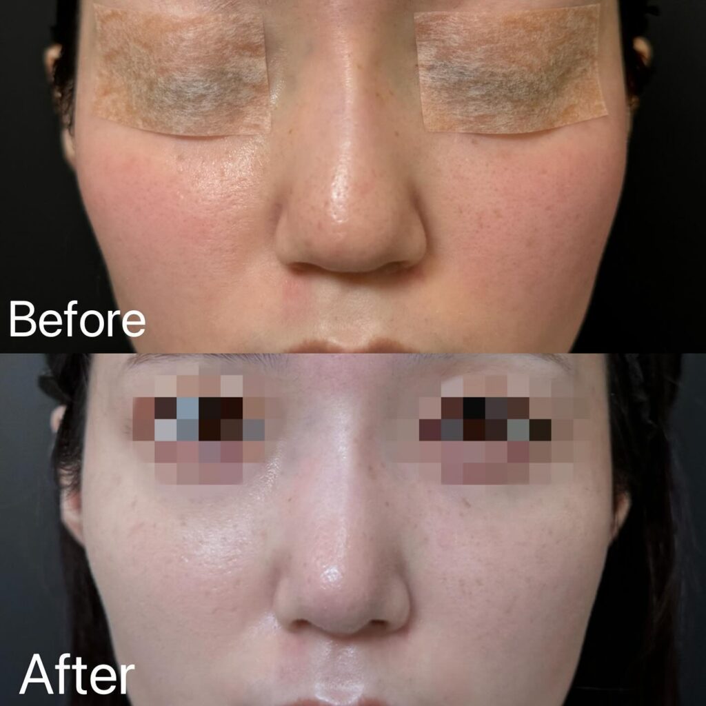 鼻尖形成と軟骨移植の症例写真 (2)