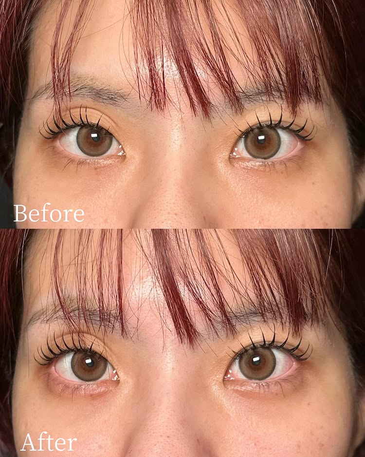 涙袋のヒアルロン酸の症例写真 (11)