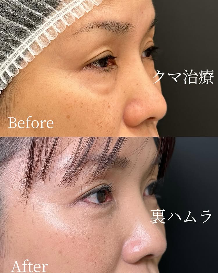 裏ハムラ法の症例写真 (47)