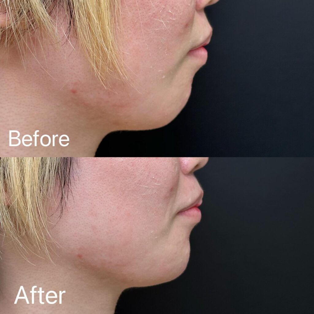 顎のヒアルロン酸注入の症例写真 (2)