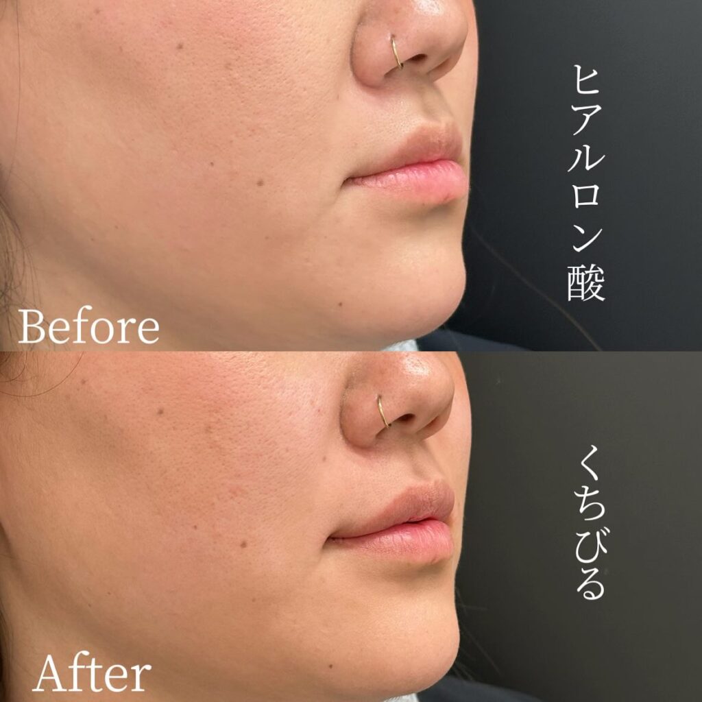 唇のヒアルロン酸の症例写真 (32)