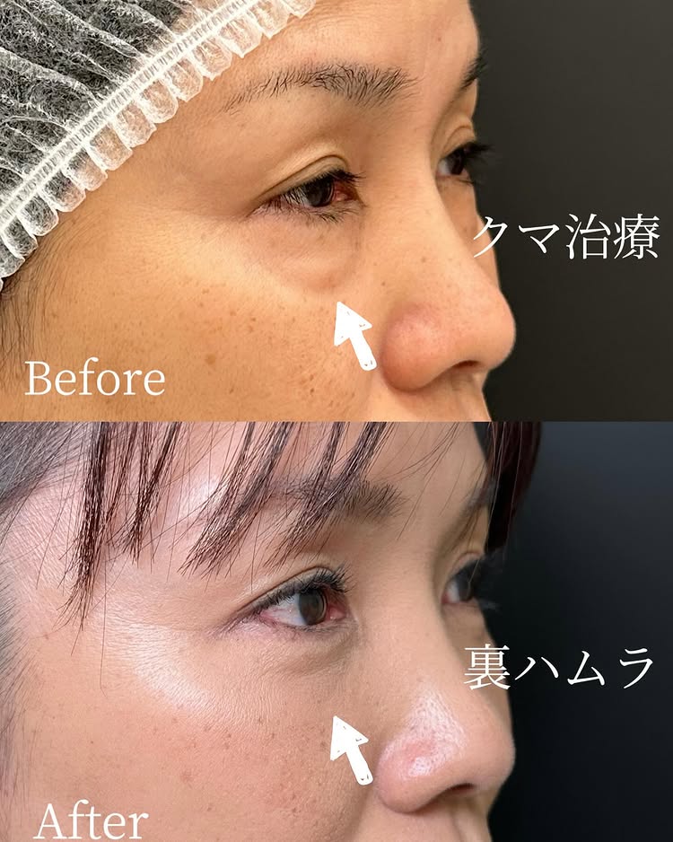 裏ハムラ法の症例写真 (48)