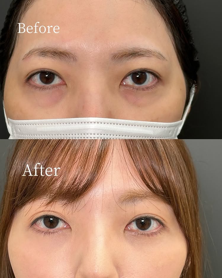 裏ハムラ法の症例写真 (60)