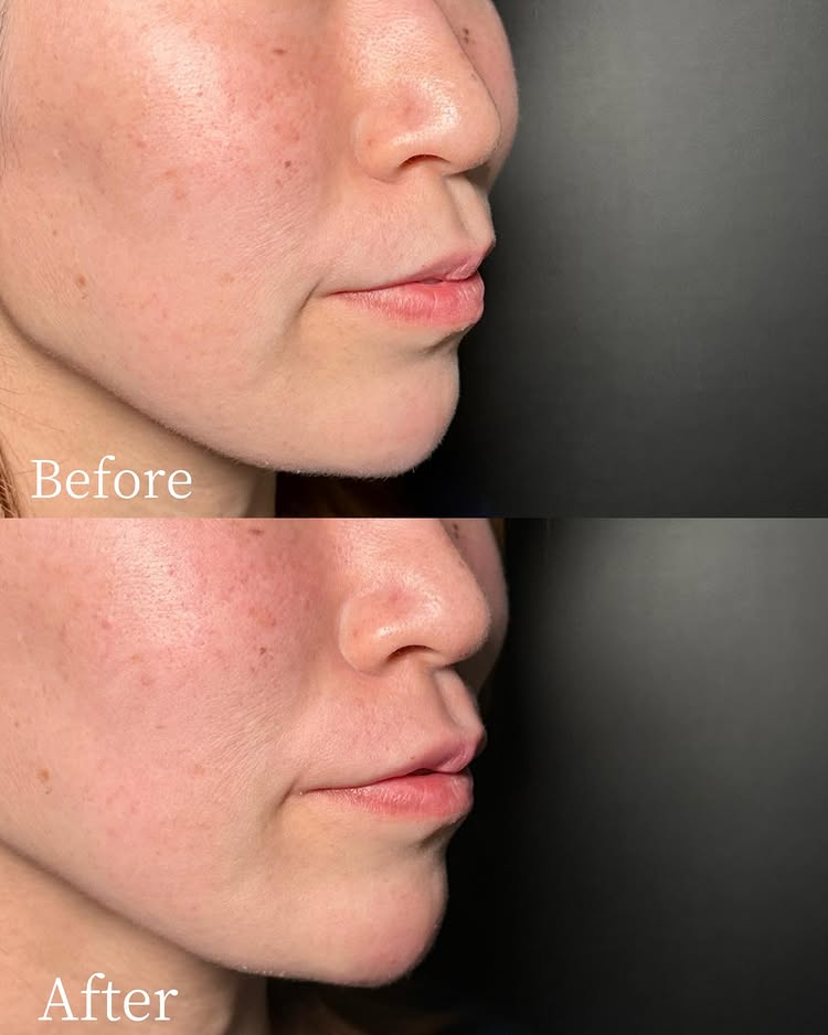 唇のヒアルロン酸の症例写真 (57)