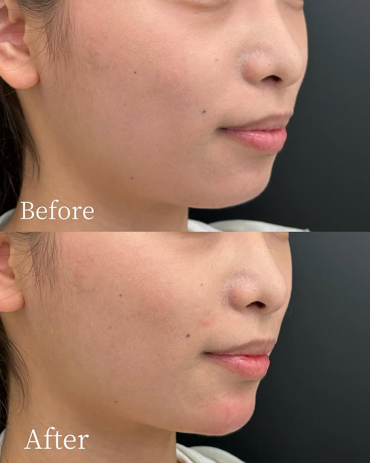 顎のヒアルロン酸の症例写真 (24)