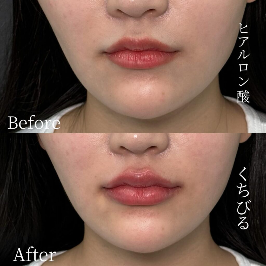 唇のヒアルロン酸の症例写真 (34)
