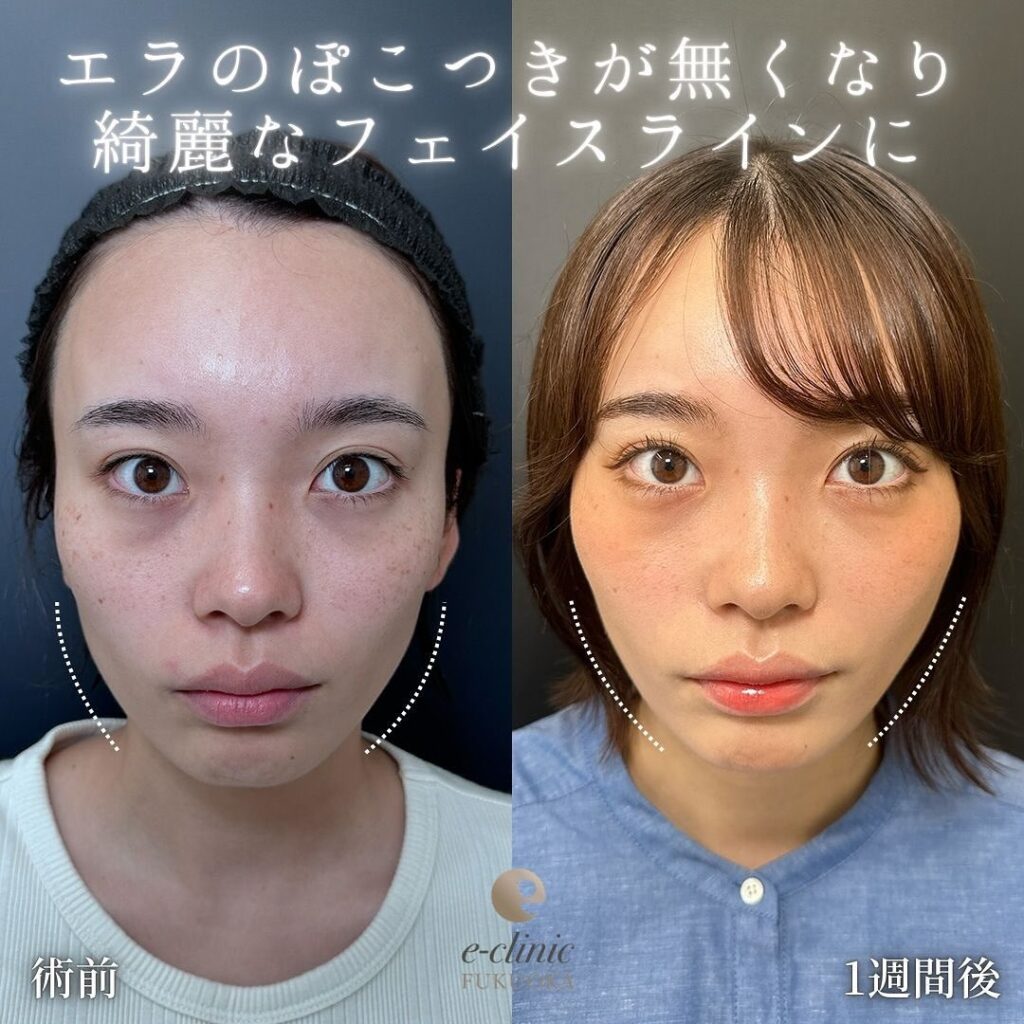 糸リフトの症例写真 (8)