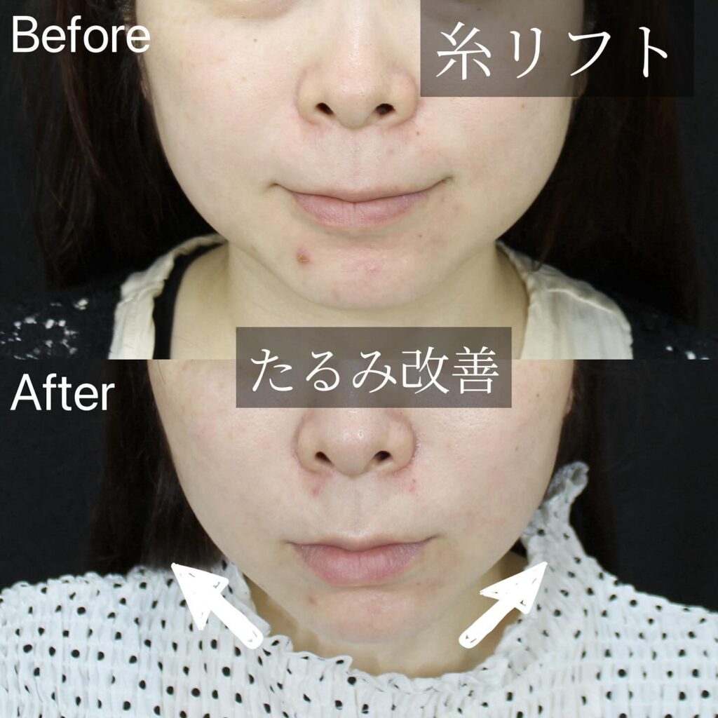 糸リフトの症例写真 (8)