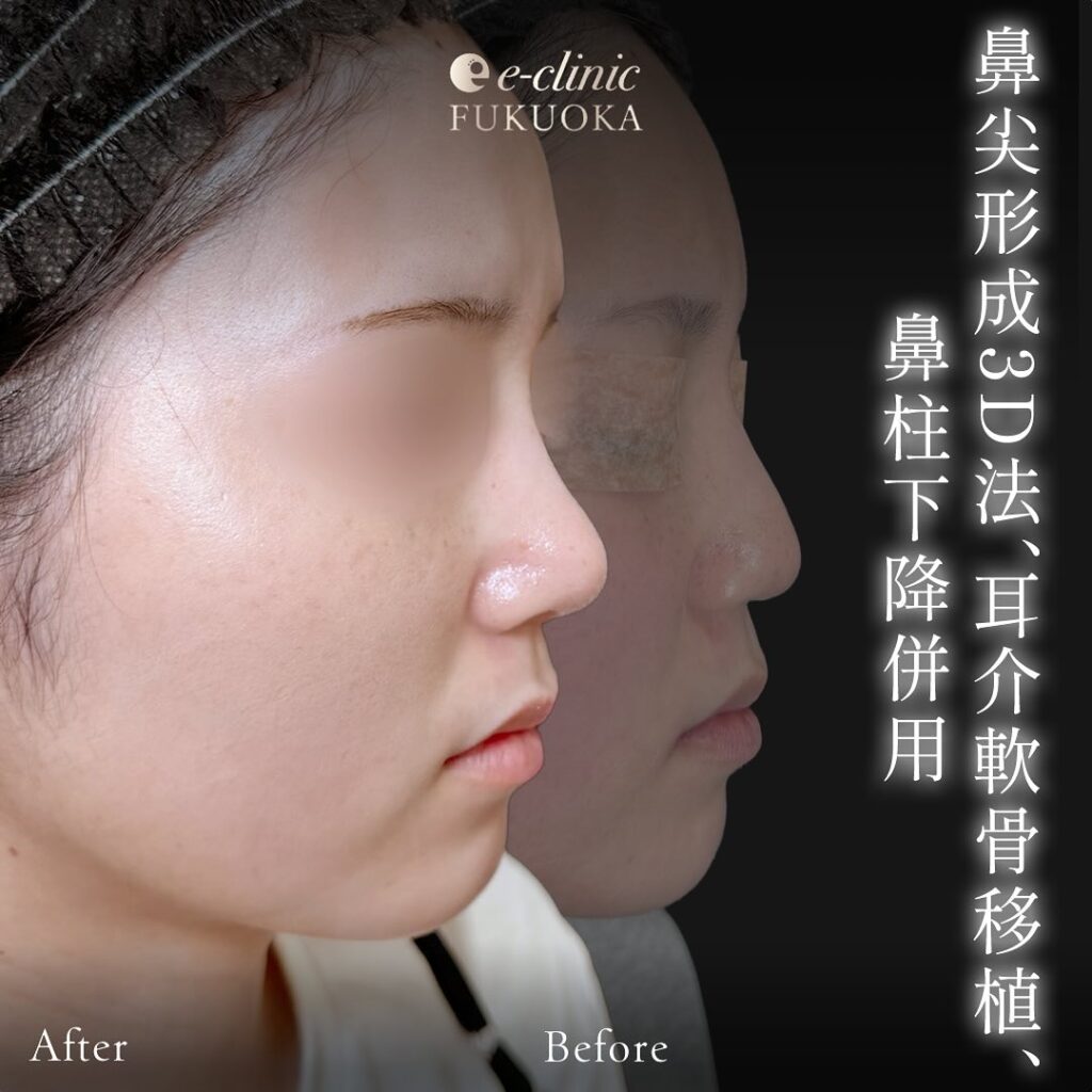 鼻尖形成と軟骨移植と鼻柱下降の症例写真 (1)