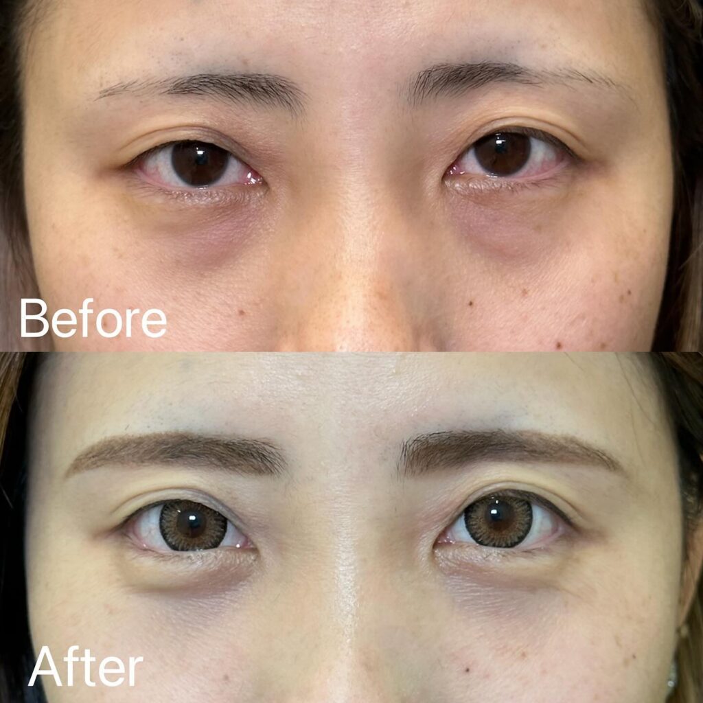 裏ハムラ法の症例写真 (20)