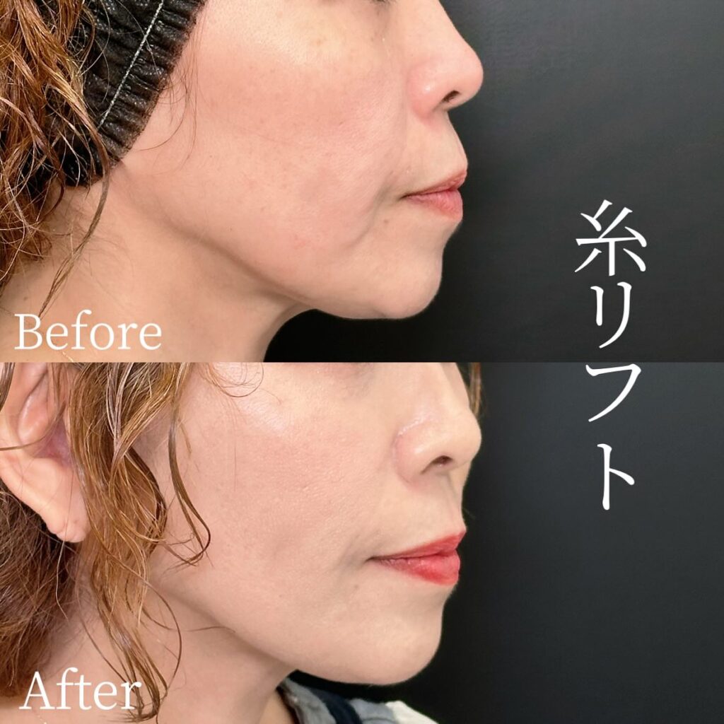 糸リフトの症例写真 (32)