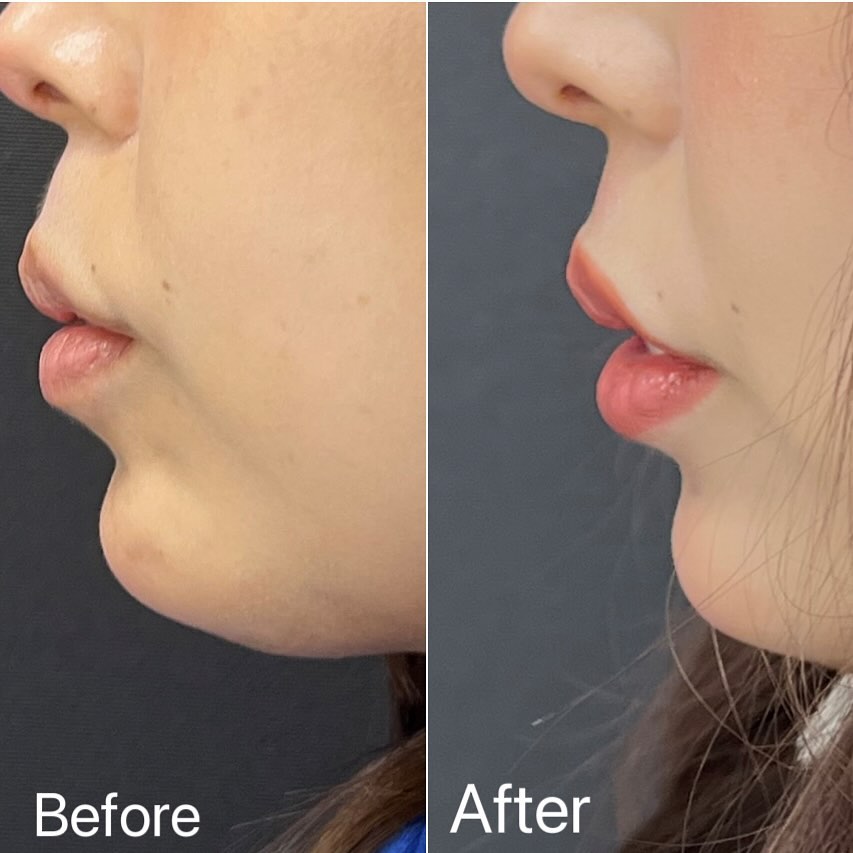 唇のヒアルロン酸の症例写真 (19)