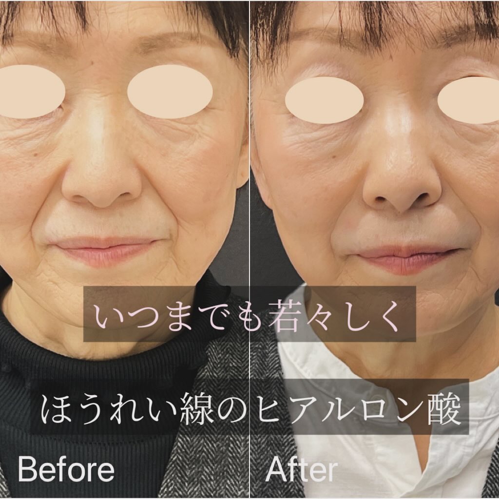 ほうれいの線ヒアルロン酸注入の症例写真 (1)