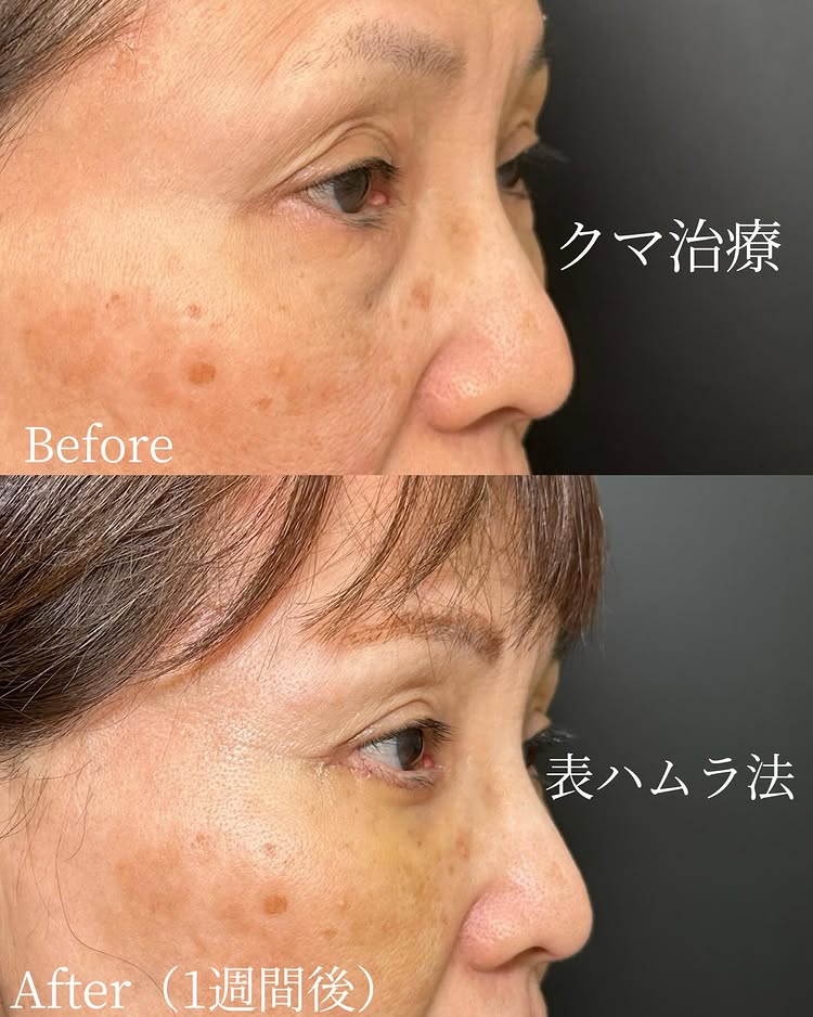 表ハムラ法の症例写真 (1)