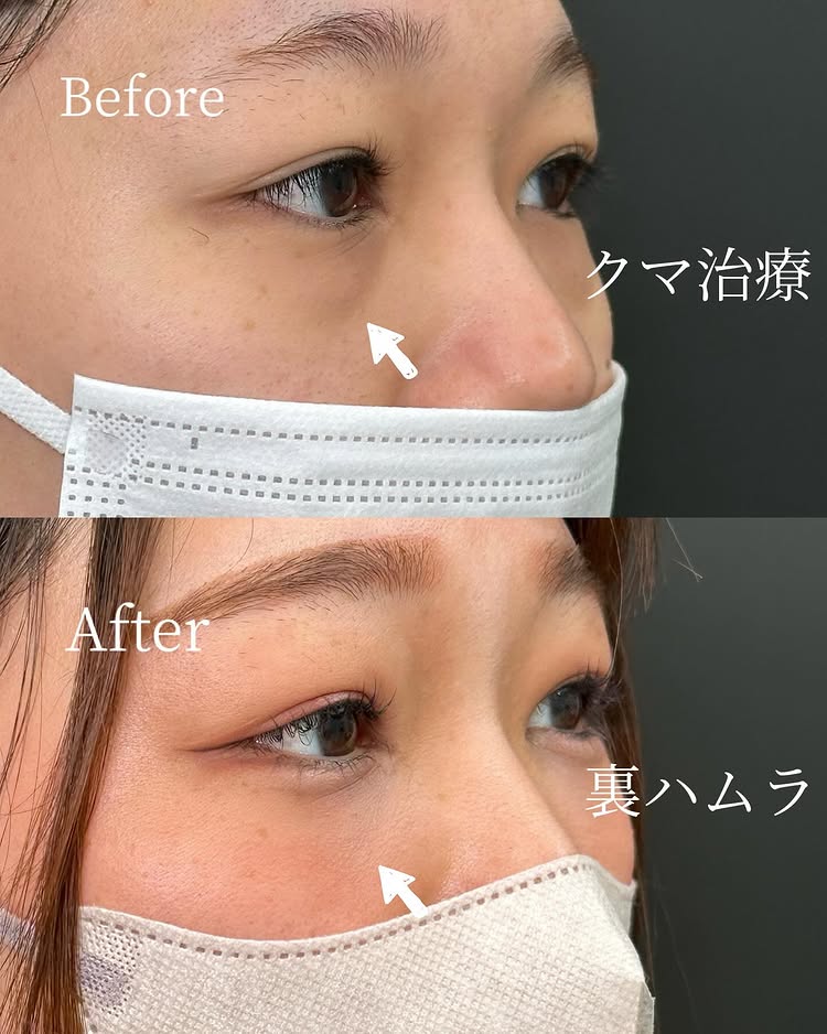 裏ハムラ法の症例写真 (55)