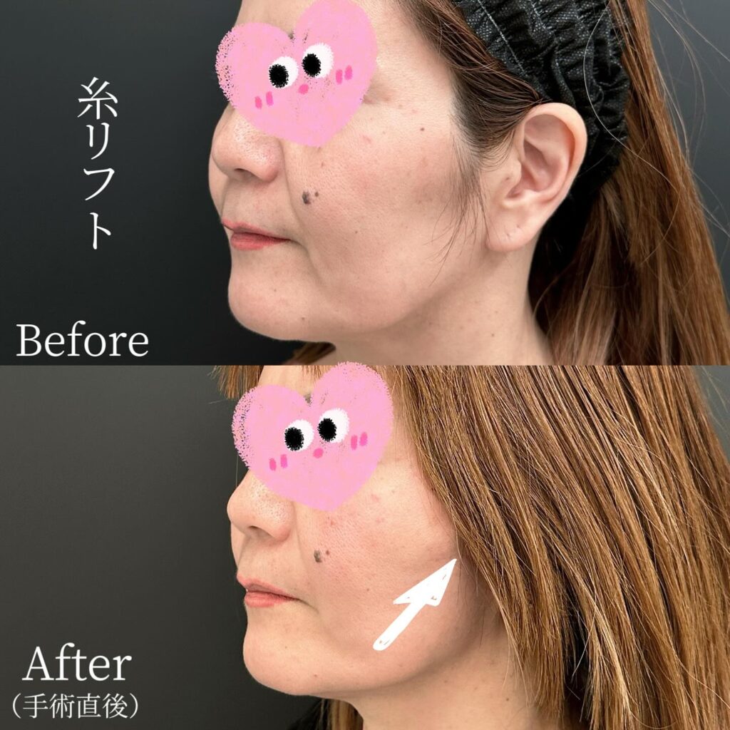 糸リフトの症例写真 (37)