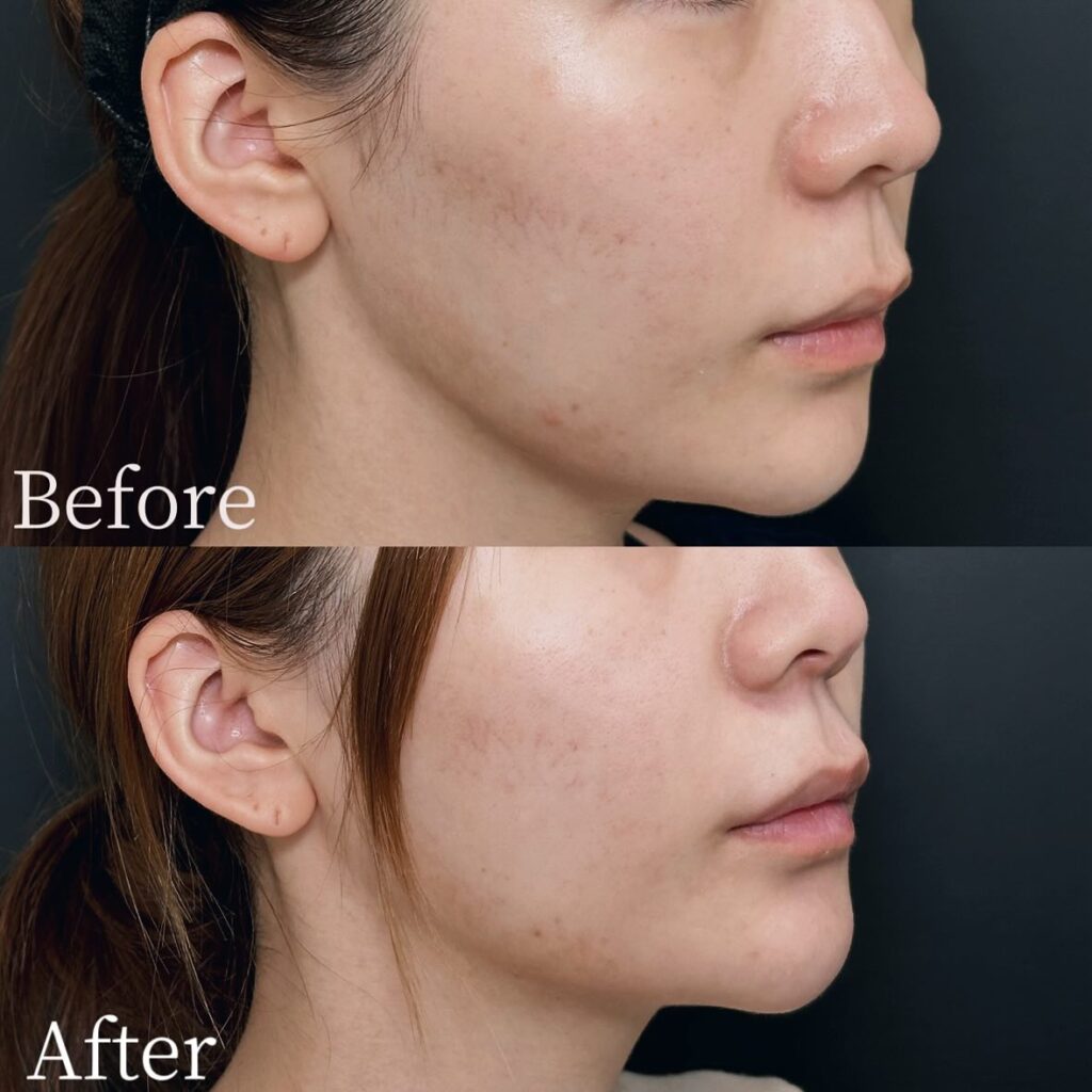 糸リフトの症例写真 (17)