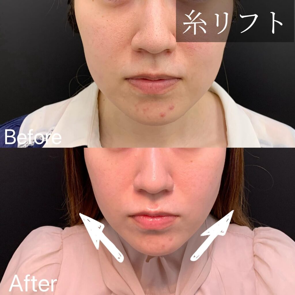 糸リフトの症例写真 (10)