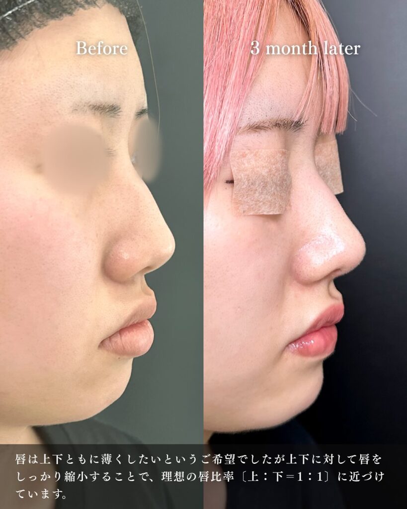 鼻尖形成と軟骨移植と口唇縮小の症例写真 (5)