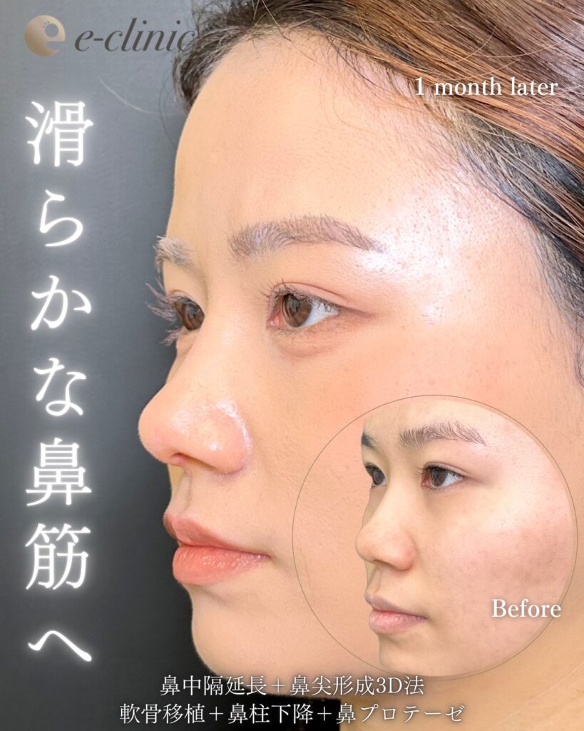 鼻中隔延長と鼻尖形成と軟骨移植と鼻柱下降とプロテーゼの症例写真 (1)