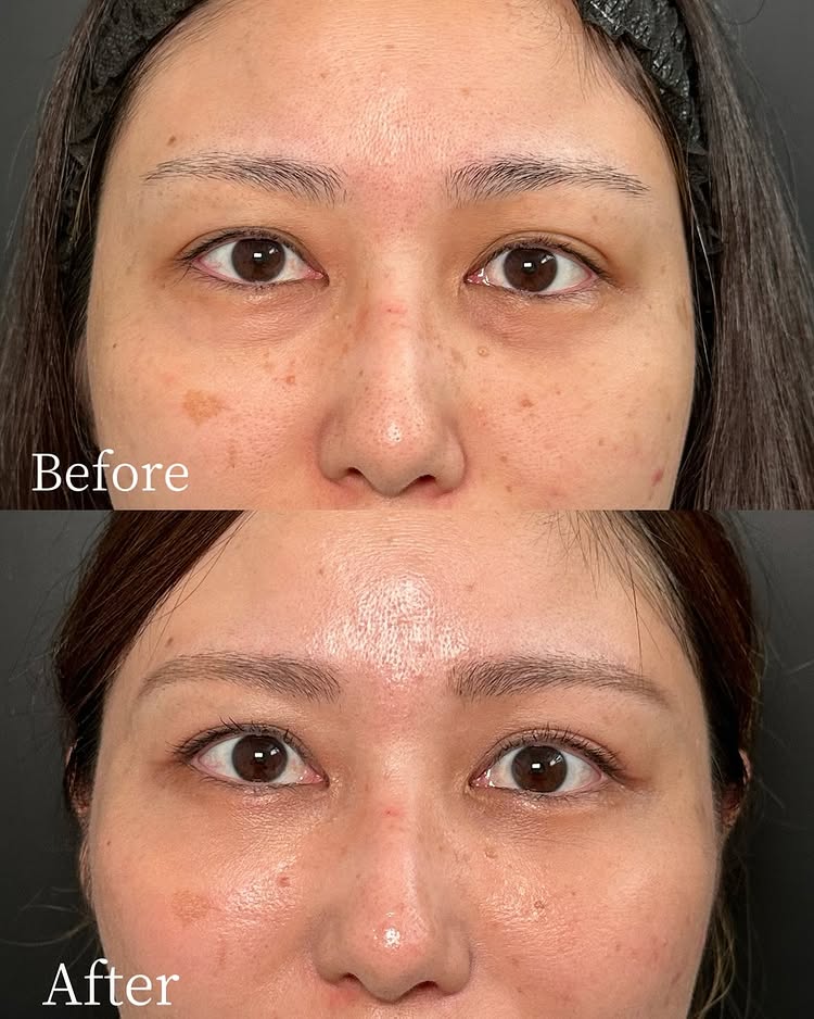 裏ハムラ法の症例写真 (74)