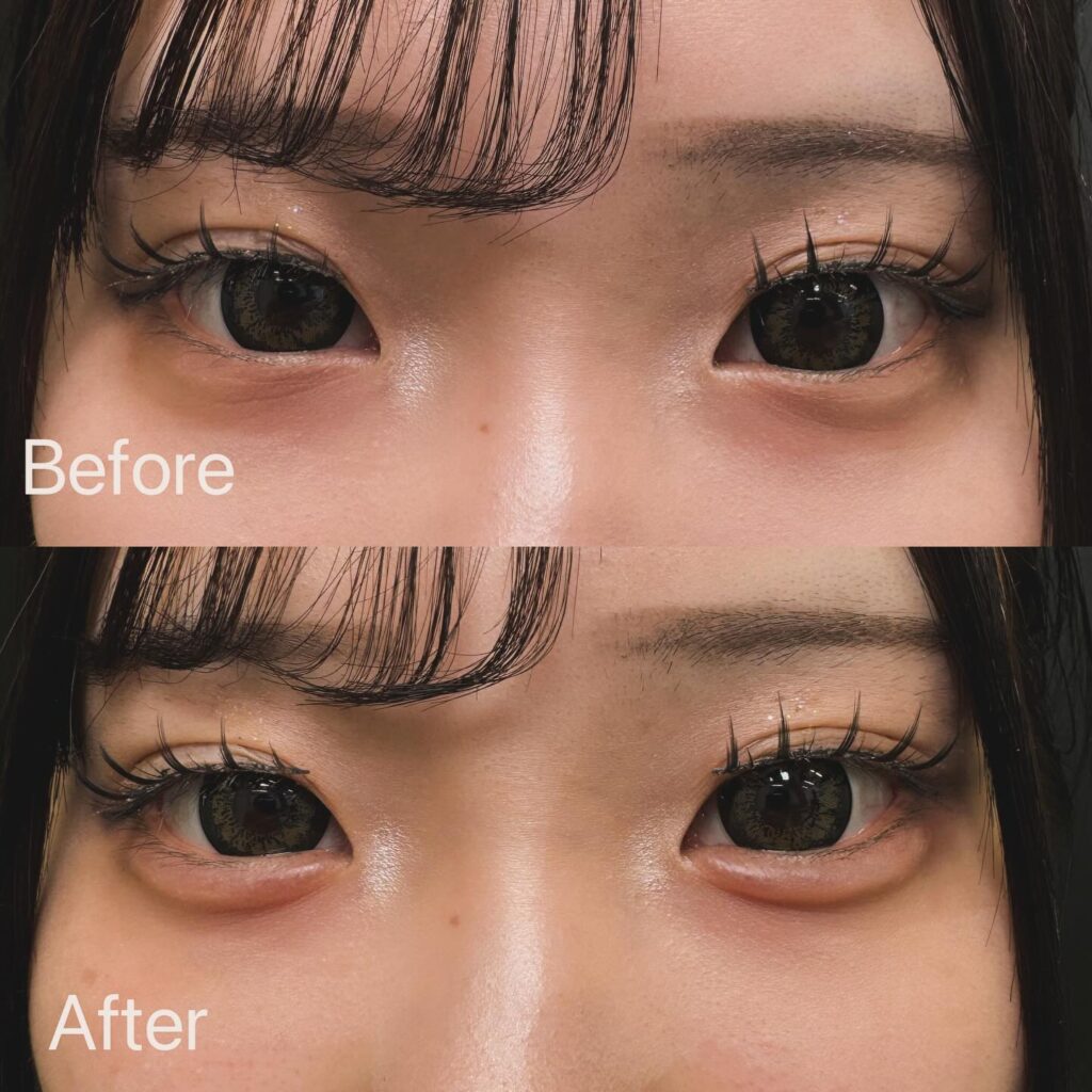 涙袋のヒアルロン酸の症例写真 (4)