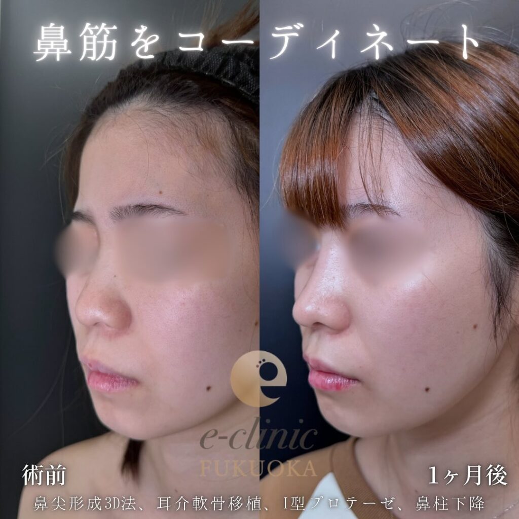 鼻尖形成と軟骨移植とプロテーゼと鼻柱下降の症例写真 (4)