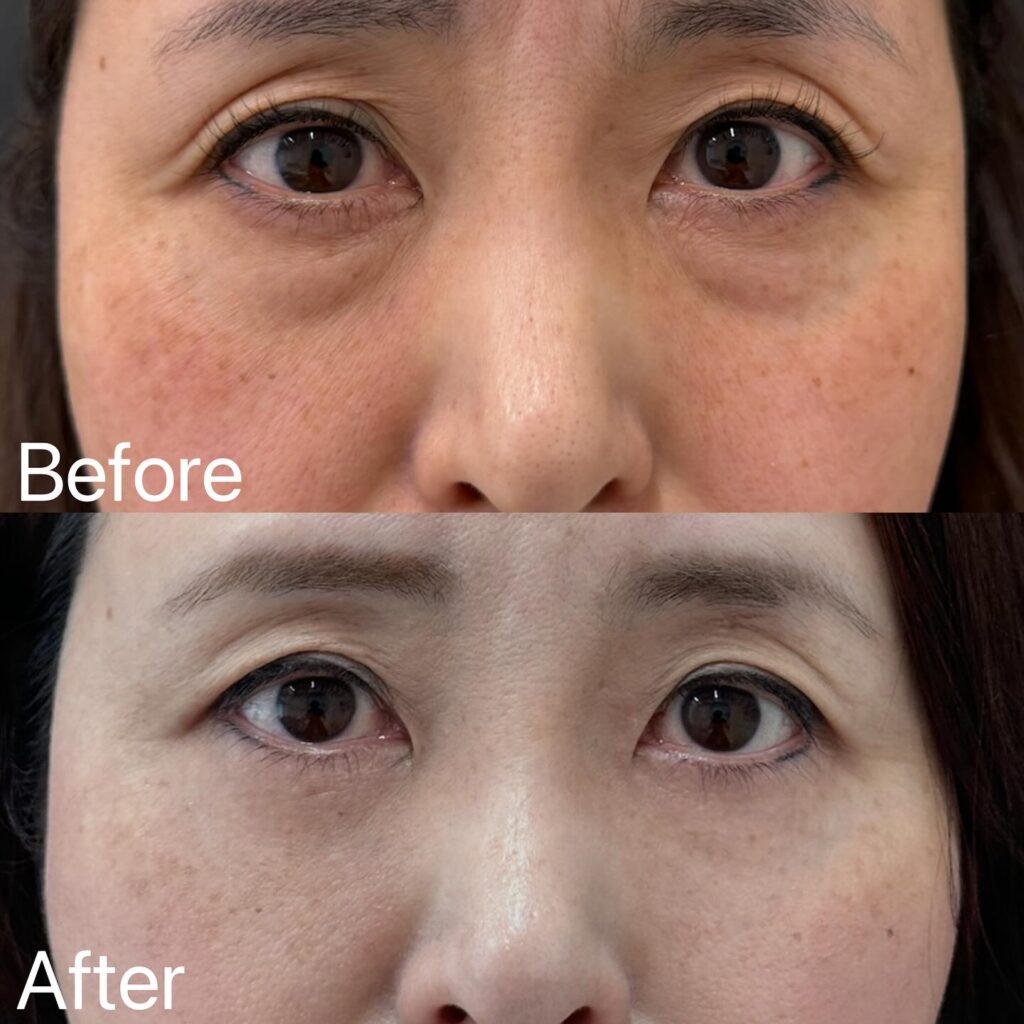 裏ハムラ法の症例写真 (22)