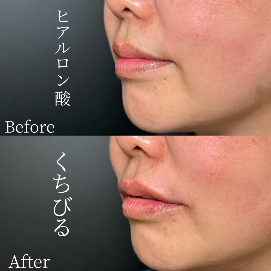 唇のヒアルロン酸の症例写真 (38)