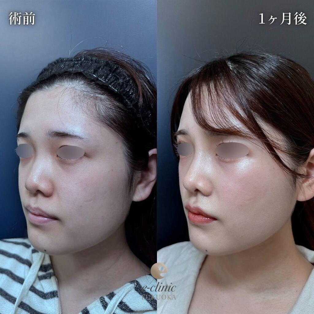 顔の脂肪吸引と糸リフトとバッカルファットの症例写真 (2)