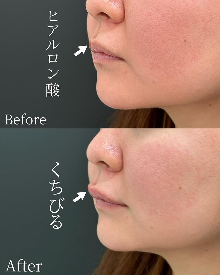 唇のヒアルロン酸の症例写真 (41)