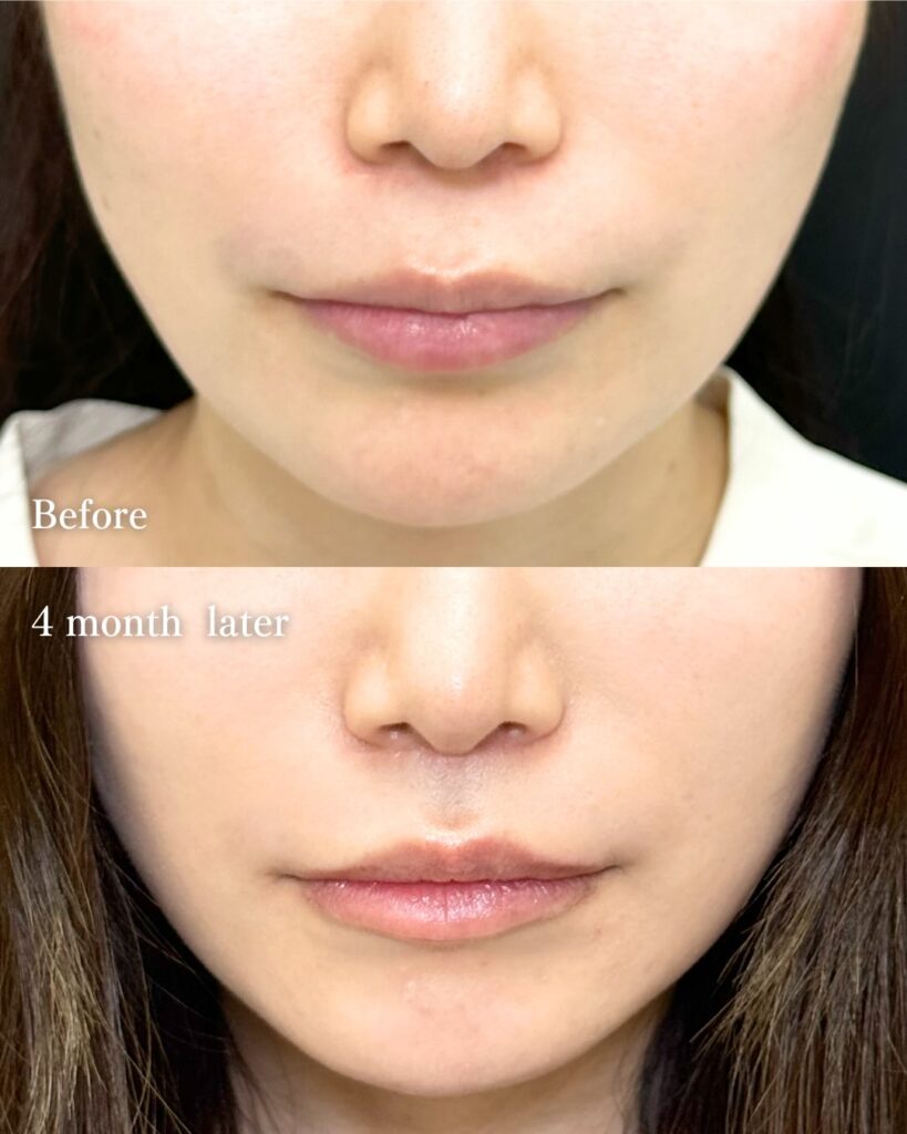 人中短縮の症例写真 (28)