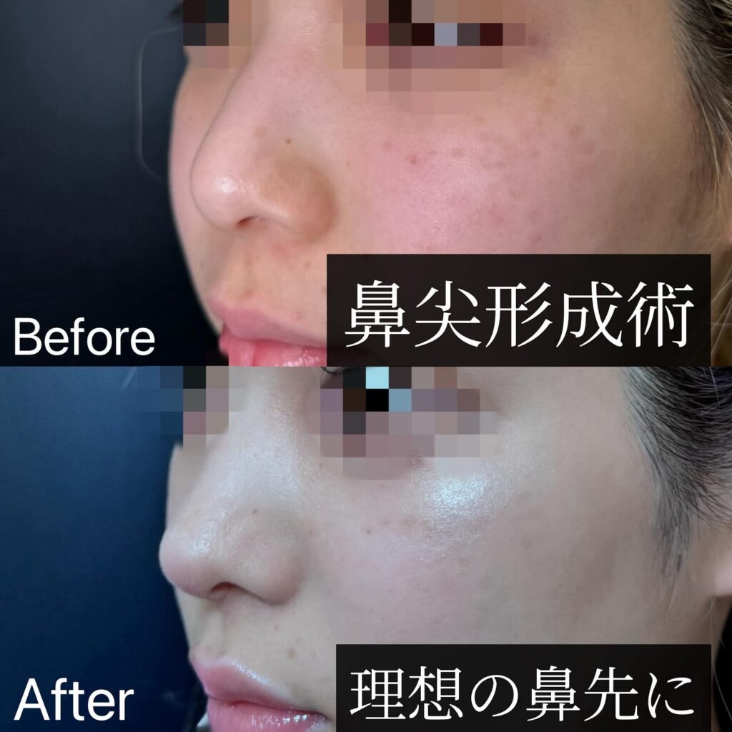 鼻尖形成と軟骨移植の症例写真 (3)