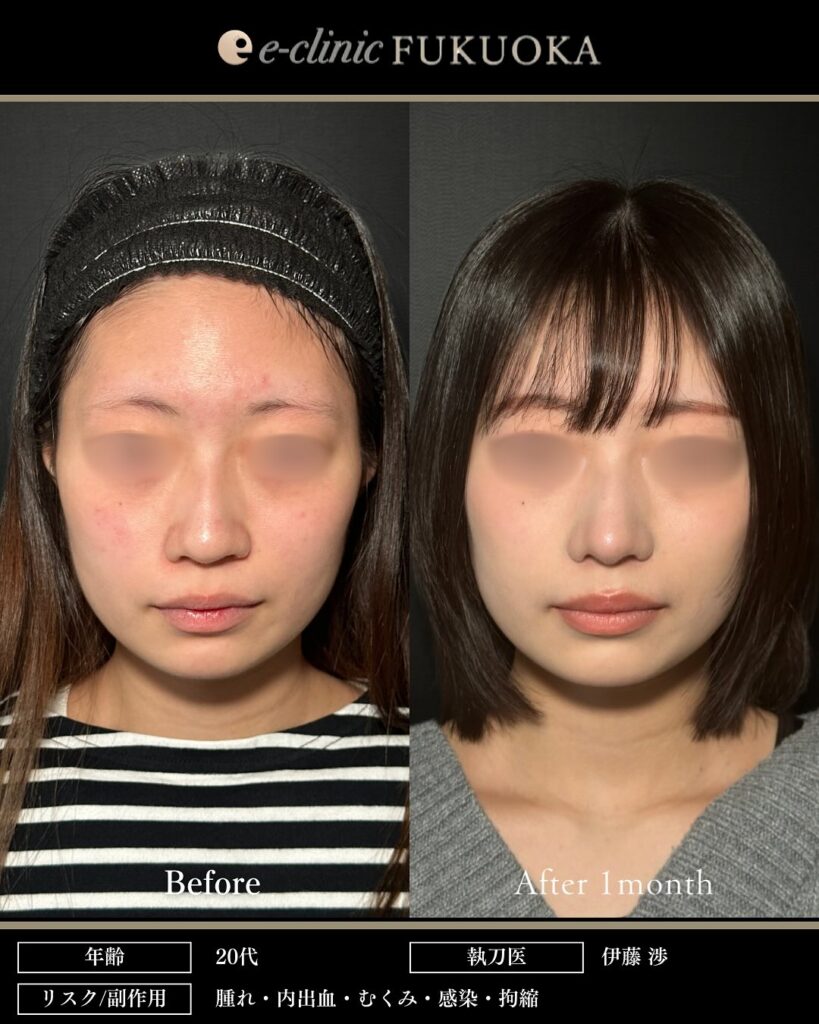 鼻尖形成と耳介軟骨移植と小鼻縮小と鼻柱下降の症例写真 (4)