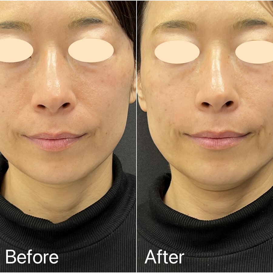 法令線のヒアルロン酸の症例写真 (4)