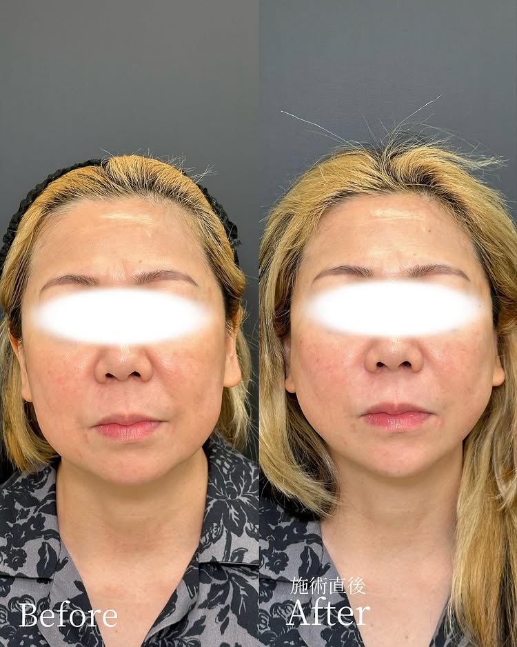 糸リフトの症例写真 (49)