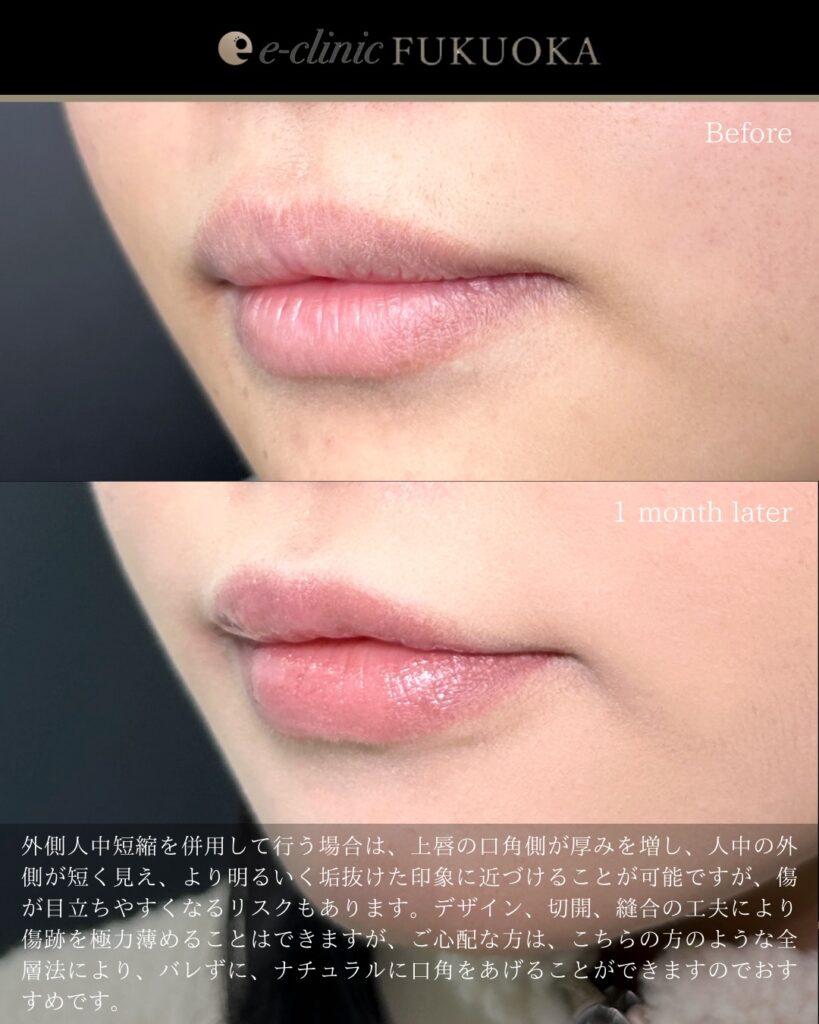 口角挙上の症例写真 (2)