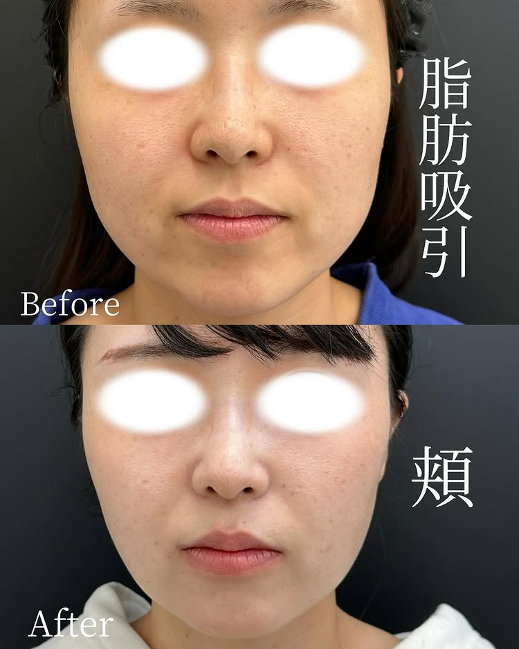 頬の脂肪吸引の症例写真 (3)