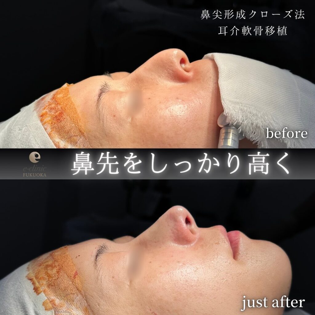 腫れ・内出血・傷跡・だるさ・熱感・頭痛・痒み・浮腫・発熱等を生じる事があります。 なるべく、リスクや副作用が出ないように配慮して手術を行っています。