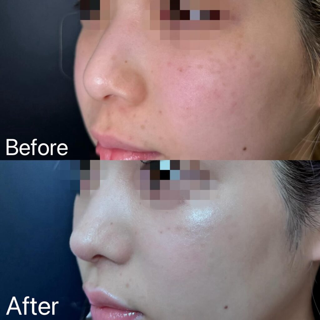 鼻尖形成と軟骨移植の症例写真 (1)