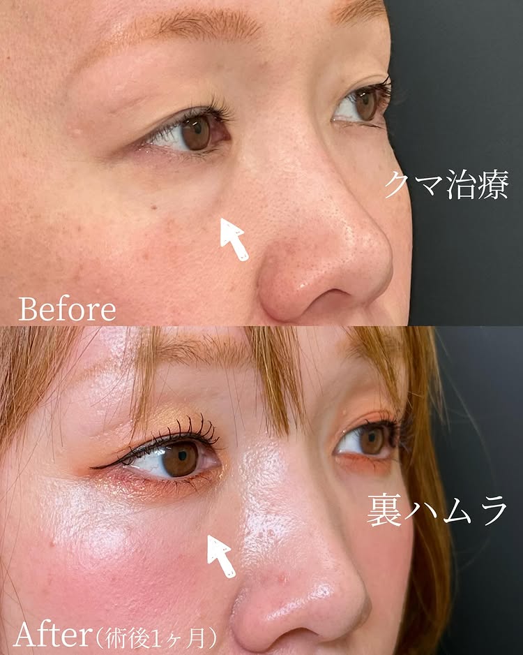 裏ハムラ法の症例写真 (52)