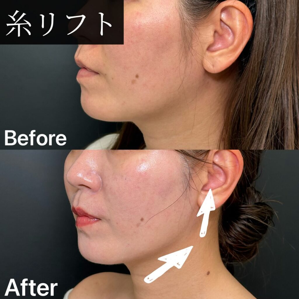 糸リフトの症例写真 (14)