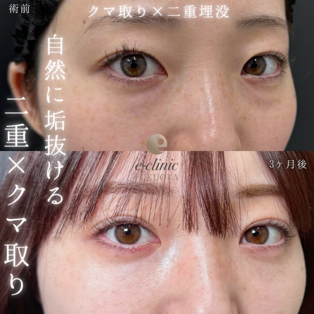 埋没法と裏ハムラ法の用例写真 (2)