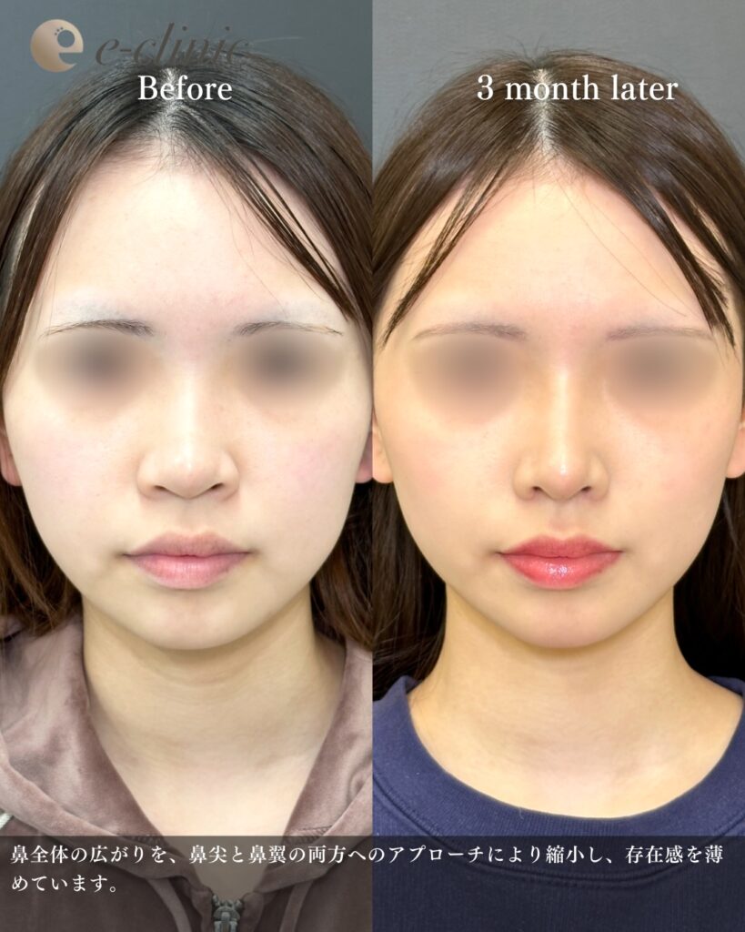 鼻尖形成と軟骨移植とプロテーゼと小鼻縮小の症例写真 (28)