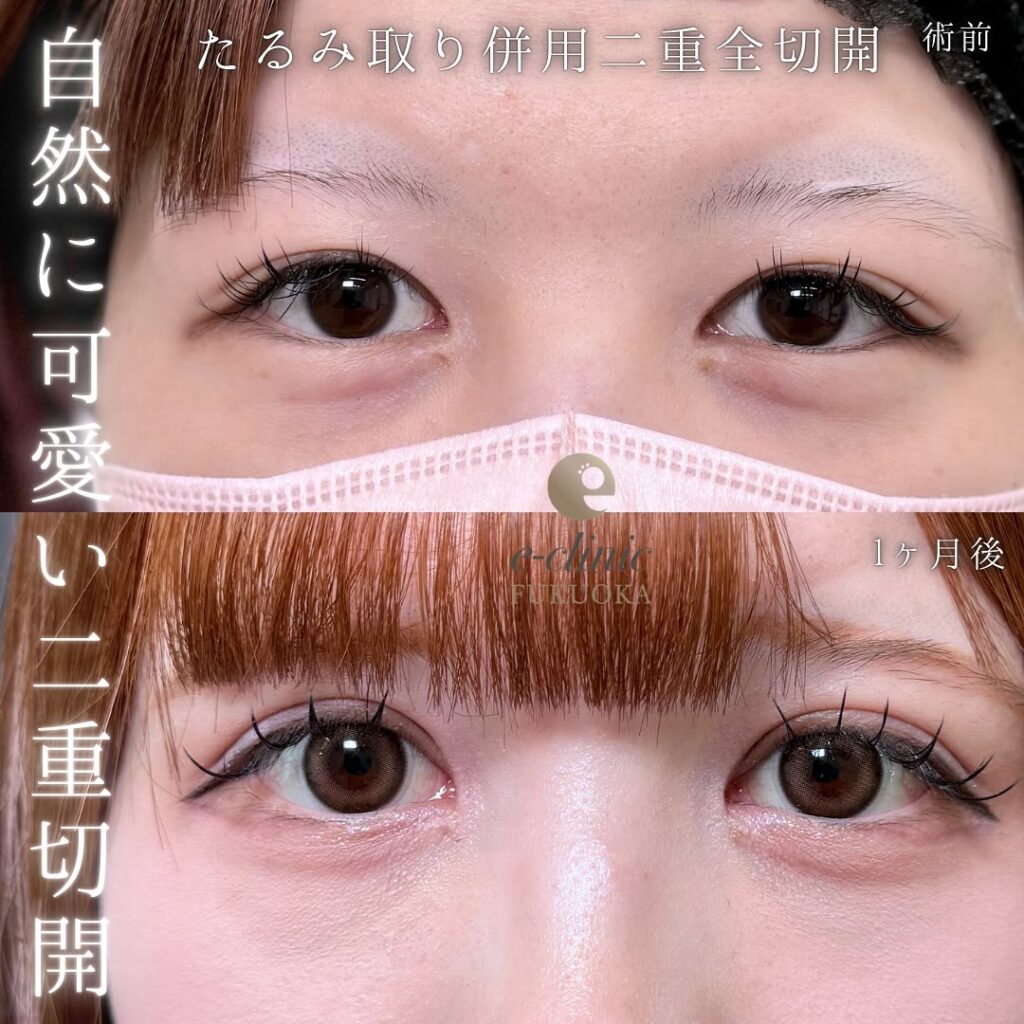 たるみ取り併用全切開の症例写真 (4)