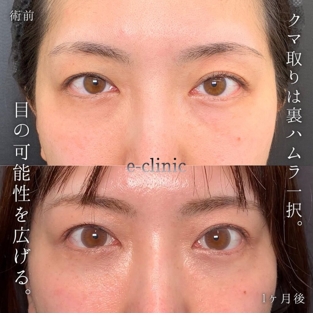 裏ハムラ法の症例写真 (17)