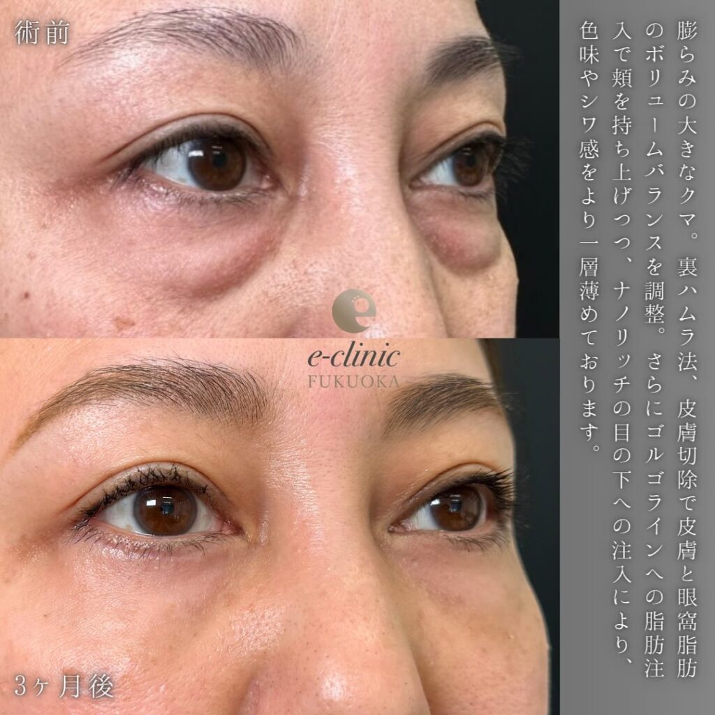 裏ハムラ法と脂肪注入の症例写真 (15)